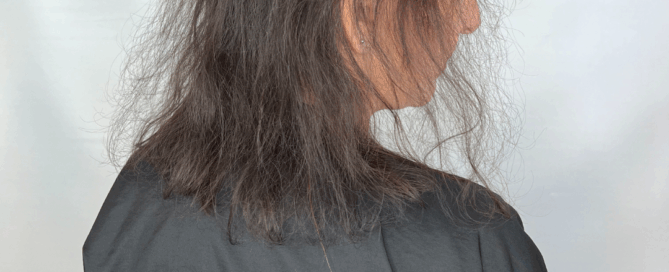 mesh integration hair loss androgenetic alopecia menopause hormonal hair loss trichotillomania thinning hair