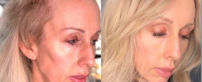 mesh integration hair loss androgenetic alopecia menopause hormonal hair loss trichotillomania thinning hair