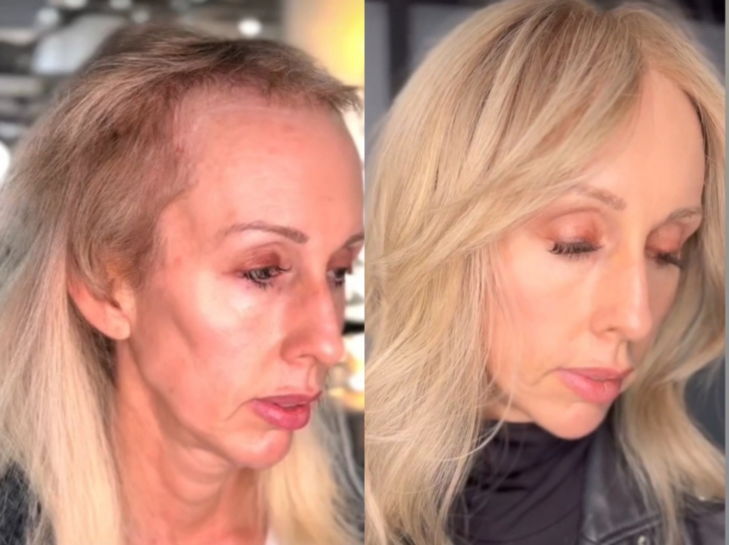 mesh integration hair loss androgenetic alopecia menopause hormonal hair loss trichotillomania thinning hair