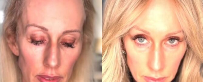 Mesh Integration Hair loss and menopause thinning hair non surgical hair replacement