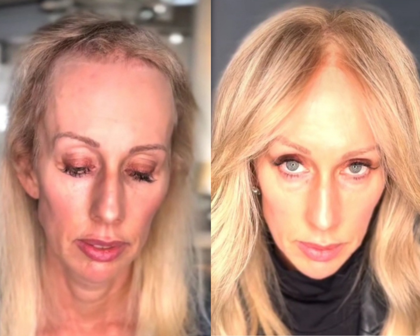 Collage_2025-02-19_12_56_00 Mesh Integration Hair loss and menopause thinning hair non surgical hair replacement