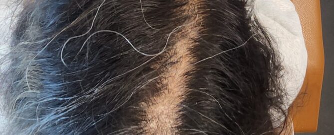 Widening part, hormonal hair loss, thinning hair, mesh integration candidate