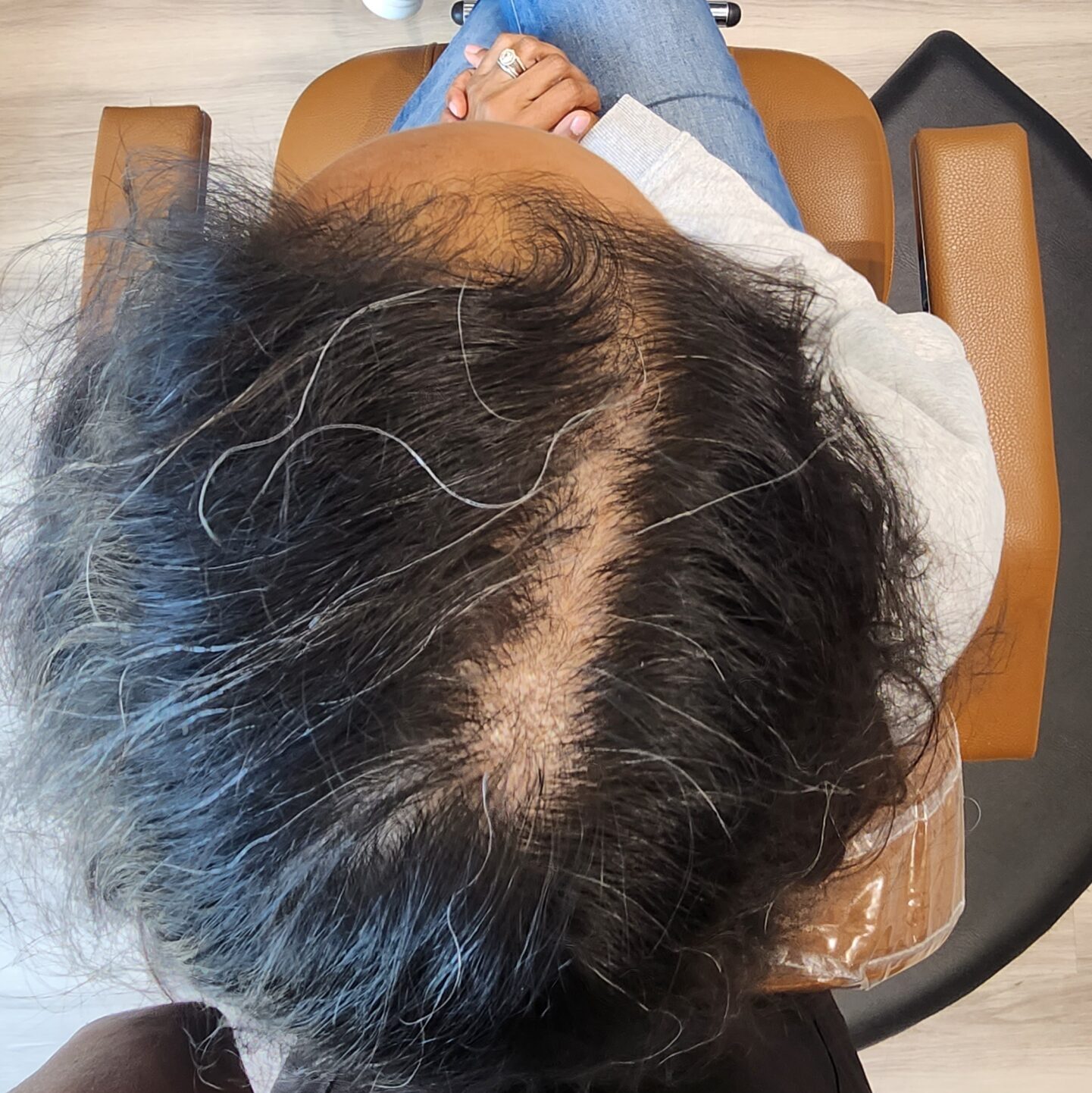 Widening part, hormonal hair loss, thinning hair, mesh integration candidate