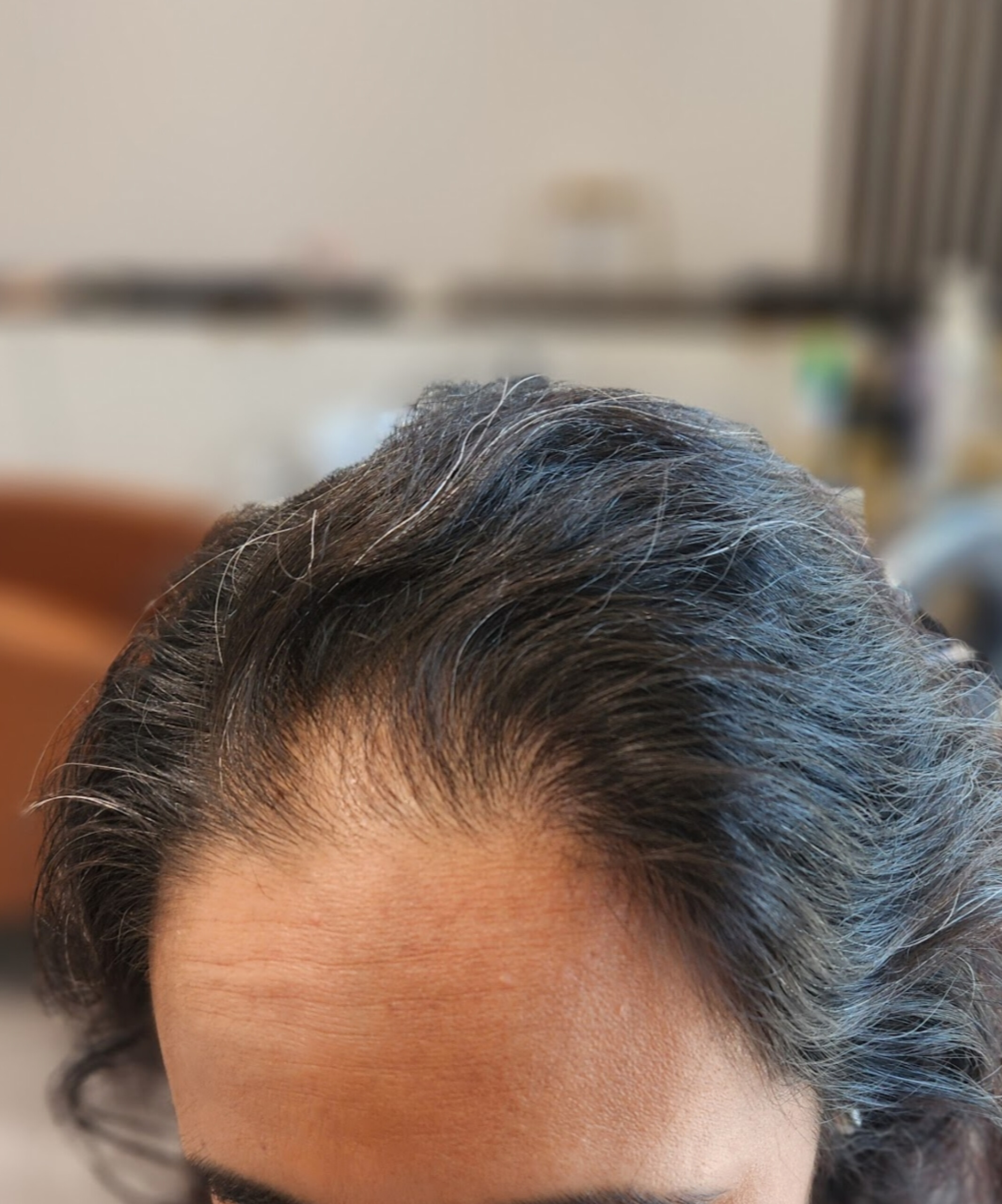 Normal pattern of thinning hair and hair loss in women
