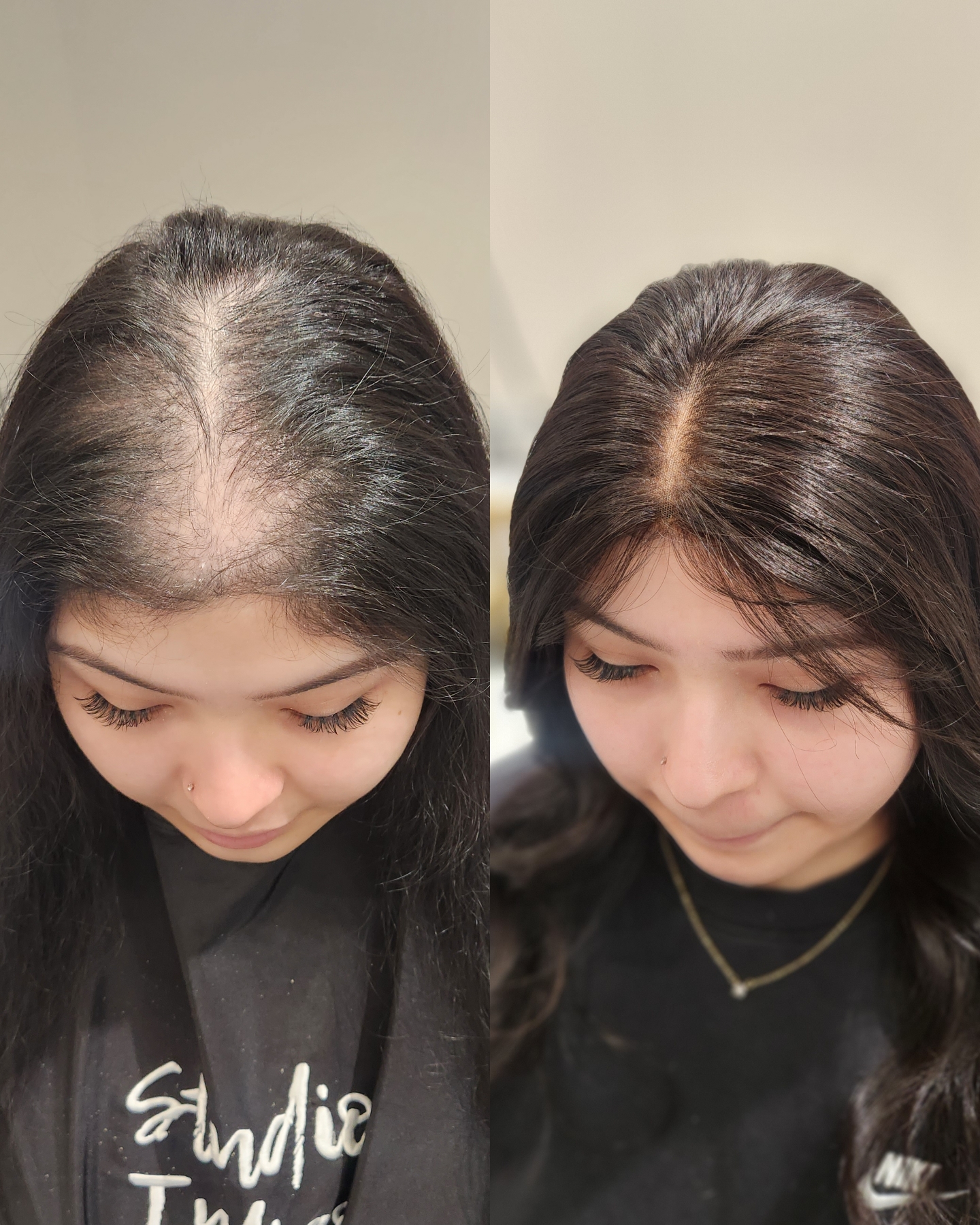 Mesh Integration Before and after extensions for hair loss