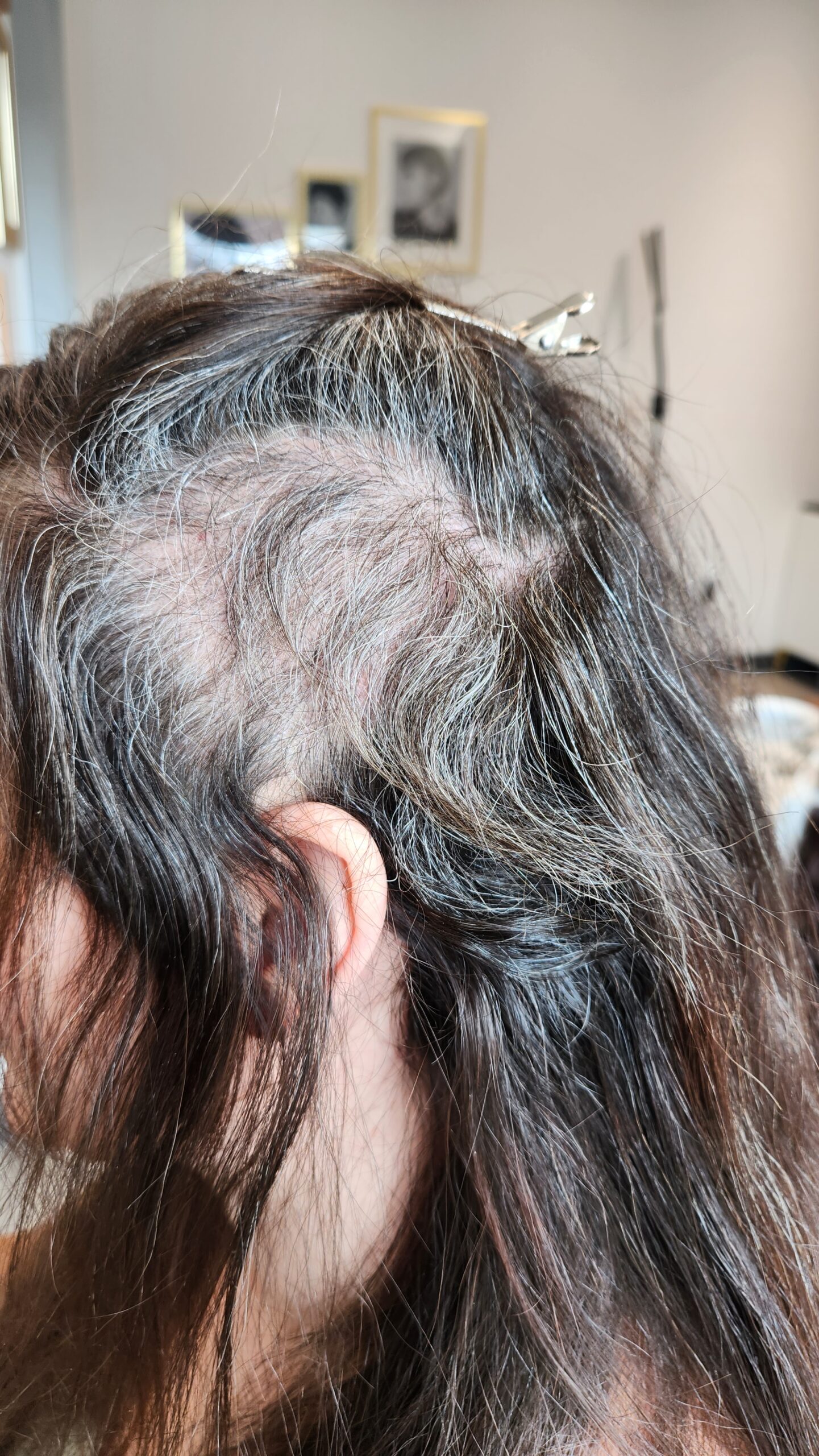20260313_111355 Trichotillomania