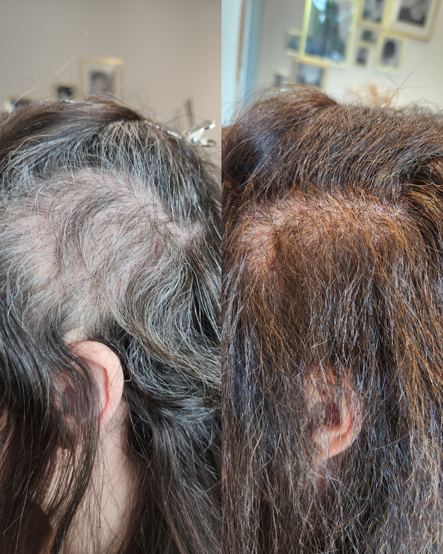 Collage_2026-06-12_17_09_08 Trichotillomania treatment progress over 12 weeks with interruption therapy