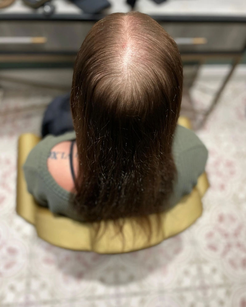 Hair loss, thinning hair, meshless integration candidate